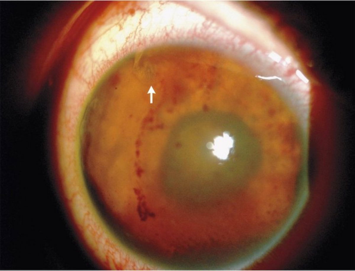 Sí, un gusano podría perforarte un ojo