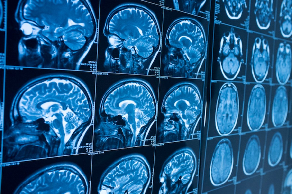 La Inteligencia Artificial detecta el Alzheimer 10 años antes que tu médico