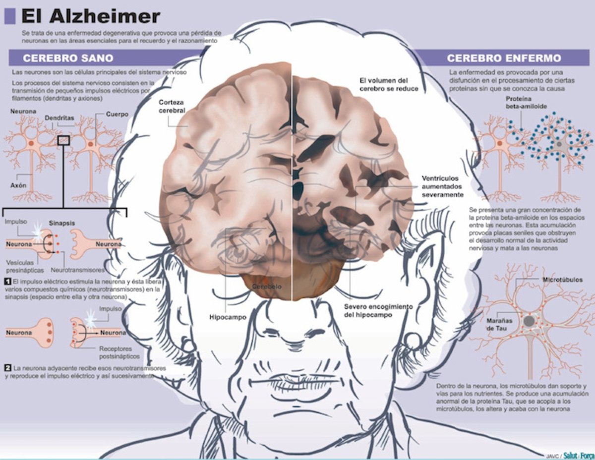 La Inteligencia Artificial detecta el Alzheimer 10 años antes que tu médico