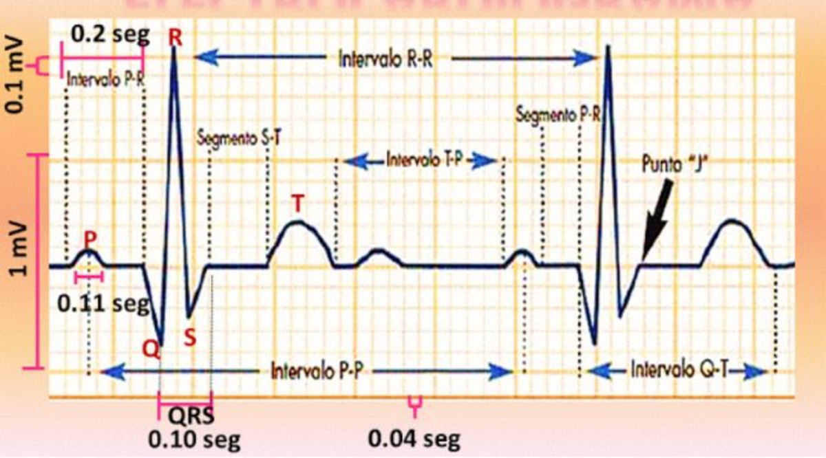 Cardiólogos vs Inteligencia Artificial, ¿quién detecta mejor los infartos?