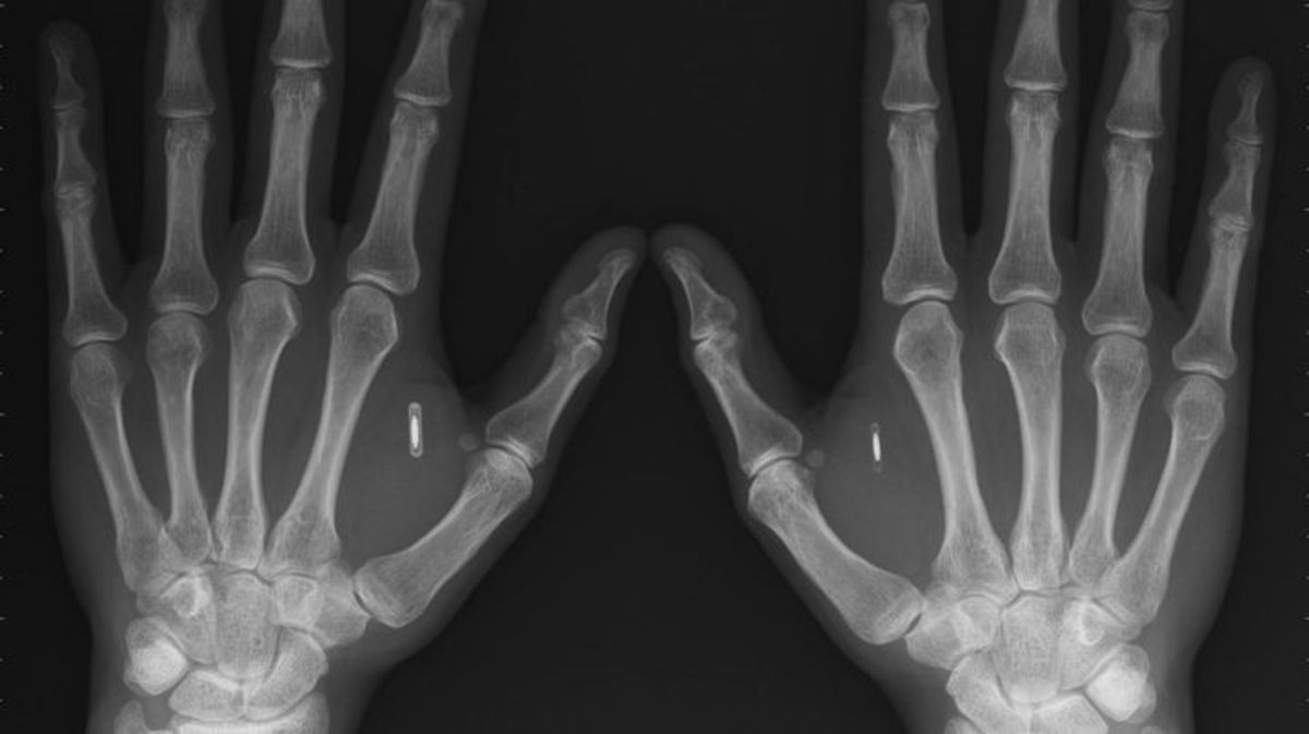 Instalar microchips bajo la piel, así es la nueva moda que está creciendo en muchos países