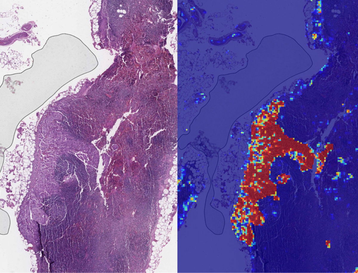 La inteligencia artificial de Google detecta antes el cáncer de mama que los humanos
