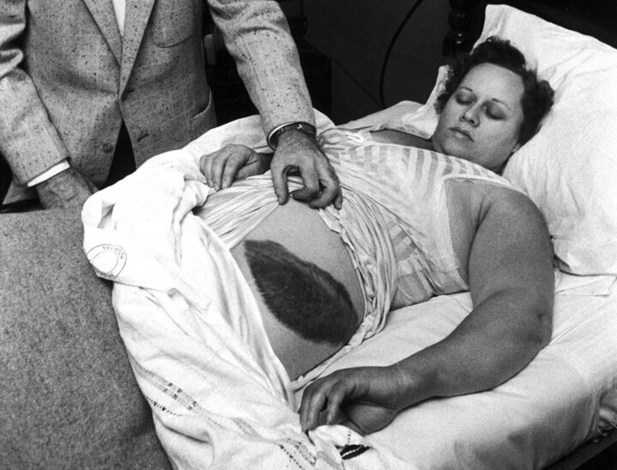 This woman is the only person to have received a meteorite impact and, believe it or not, she survived.