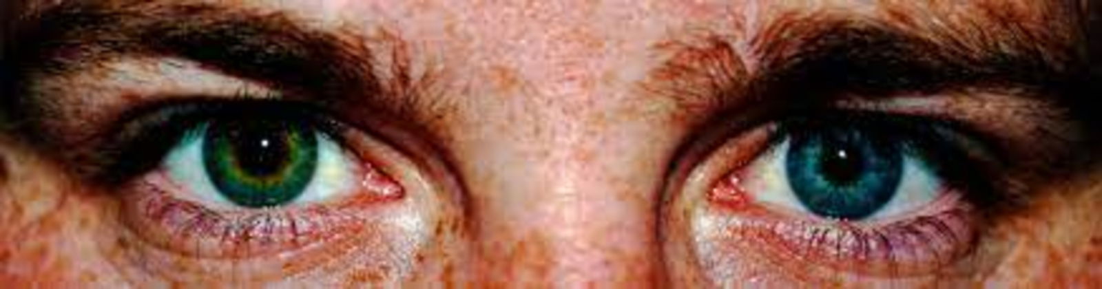 Heterocromía por qué hay gente con un ojo de cada color 3