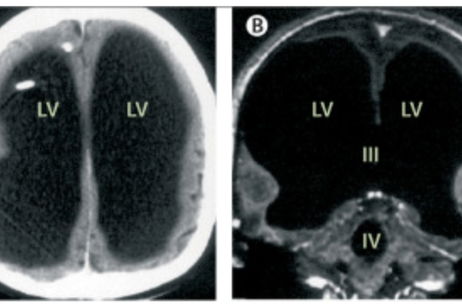 La historia del hombre al que le falta el 90% del cerebro y que vive una vida perfectamente normal