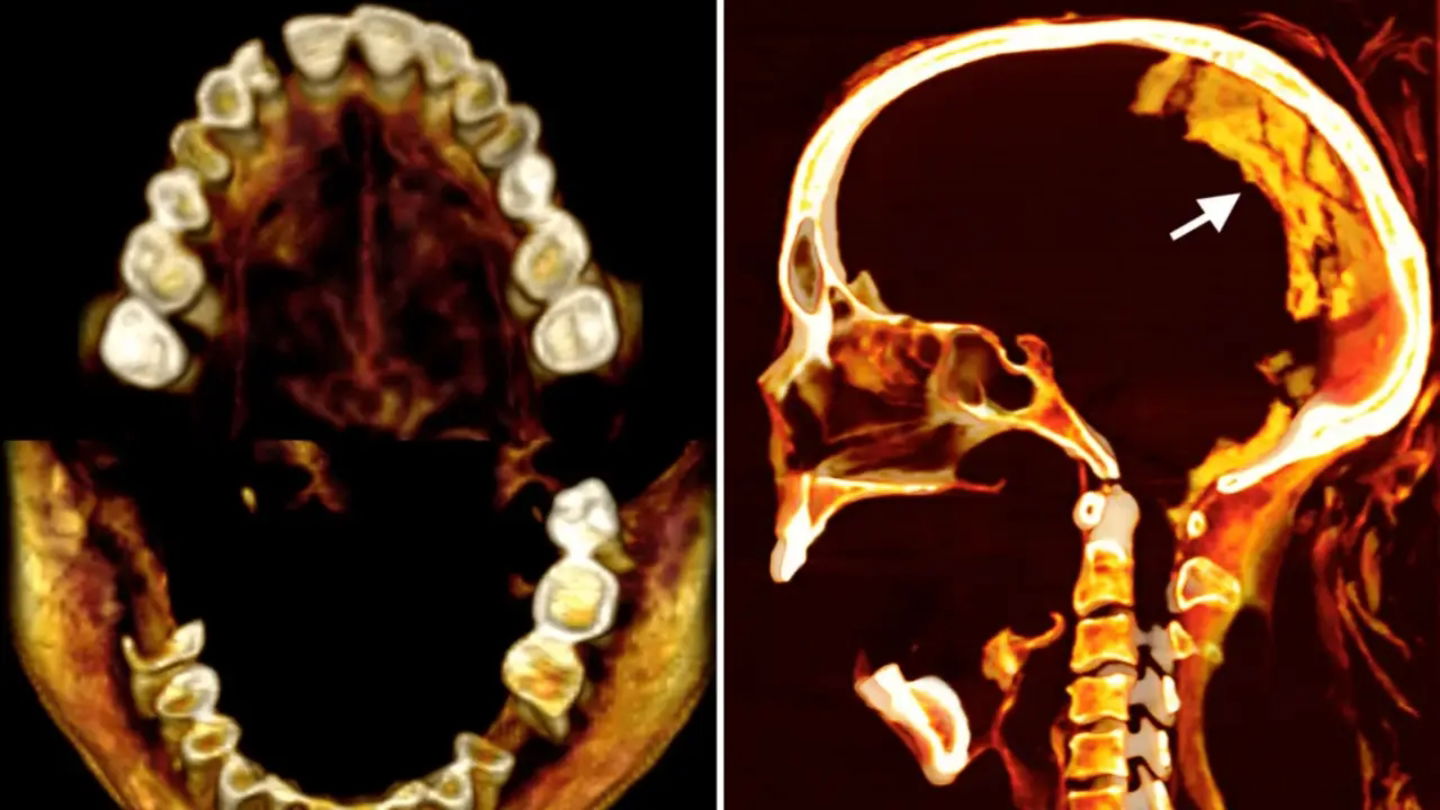 Imagen de los dientes y el cerebro de la Momia que Grita