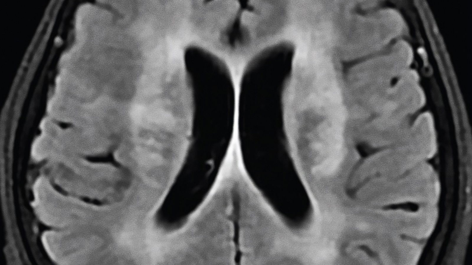 Imagen del cerebro de la mujer después del tratamiento contra bacterias que no daba resultado y donde se muestran las lesiones